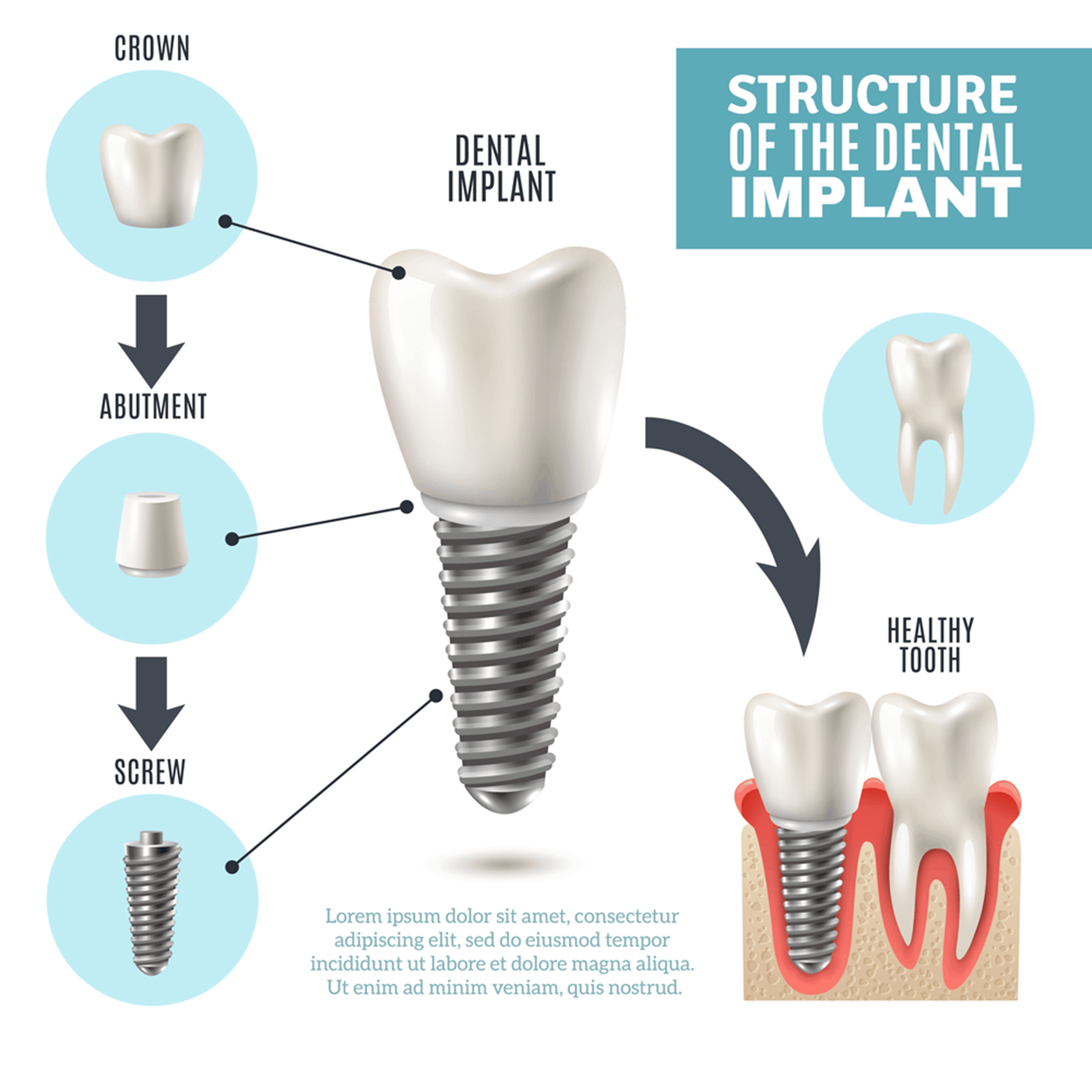 Dental Implants in Cranbrook | Dental Implants Dentist Near Me